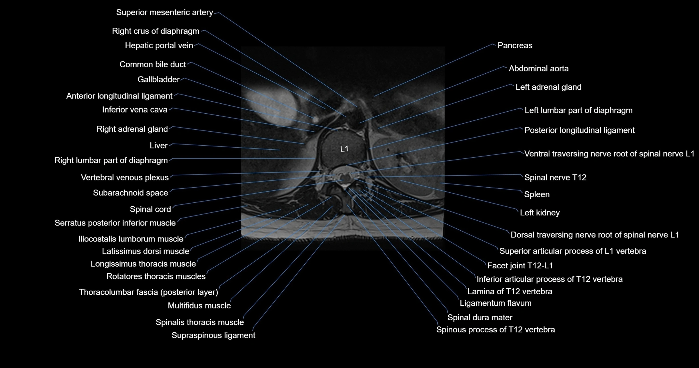MRI lumbar spine axial cross sectional anatomy 3T radiology  image-img-00001-00005.webp